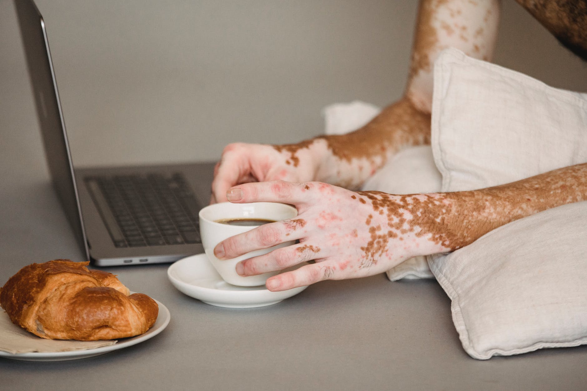 crop unrecognizable man with vitiligo using laptop and enjoying coffee